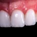 Was passiert mit Ihren natürlichen Zähnen unter Veneers?