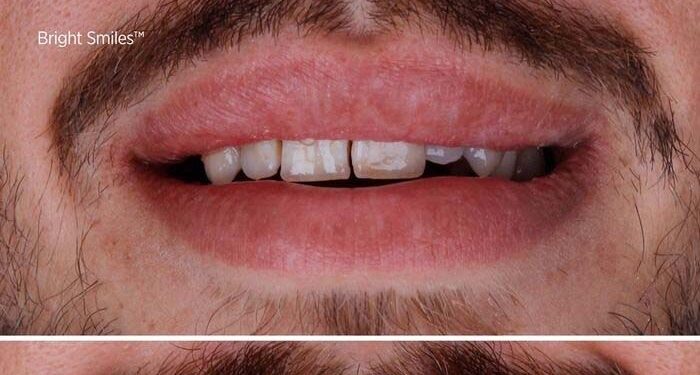 veneers türkei