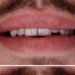 veneers türkei